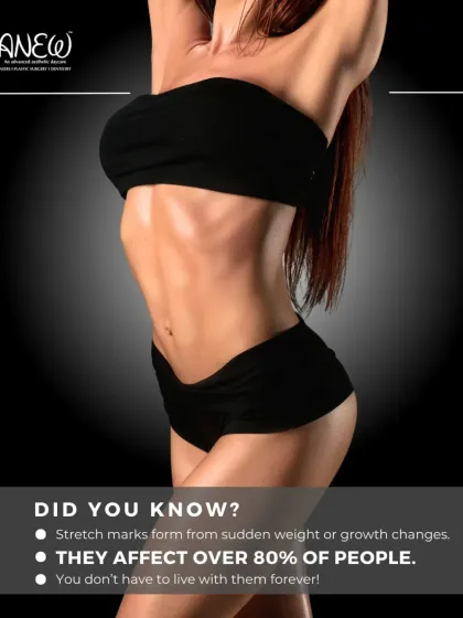 Did you know stretch marks affect over 80% of people? They often form from sudden weight or growth changes, but you don't have to live with them. Our BodyShock Mesoestetic treatment can help.