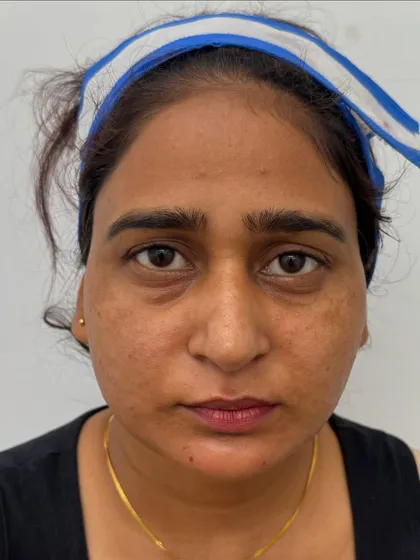 This is the "before" photo of a patient who was concerned about her tired appearance due to under-eye hollows before her wedding.