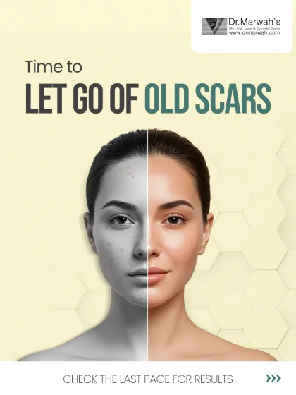 Old acne scars can be difficult to treat because they are often anchored deep in the skin. This graphic introduces our advanced approach to scar revision, moving beyond surface treatments to deliver lasting results.