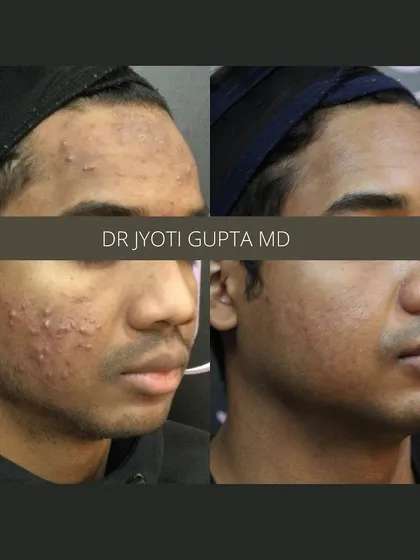 This side-profile comparison highlights the improvement in both acne lesions and post-inflammatory hyperpigmentation. A multi-step approach ensures we address all aspects of acne-prone skin.
