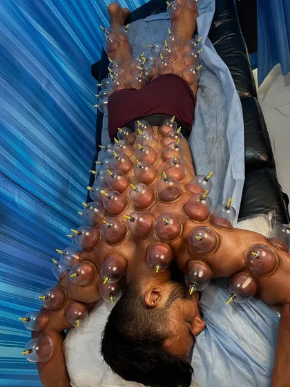This is a powerful demonstration of full-body dry cupping therapy on a professional athlete. This technique is excellent for increasing blood circulation across large muscle groups, reducing soreness, and promoting overall recovery after intense training cycles.