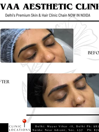 Before and after view of a combo brow treatment. This technique combines microblading strokes at the front of the brow with soft shading through the tail for added definition and a polished, long lasting look.