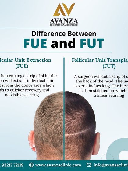 What is the difference between FUE and FUT? This graphic explains our preferred method, Follicular Unit Extraction (FUE), which involves extracting individual follicles for quicker recovery and no linear scarring, unlike the older FUT strip method.