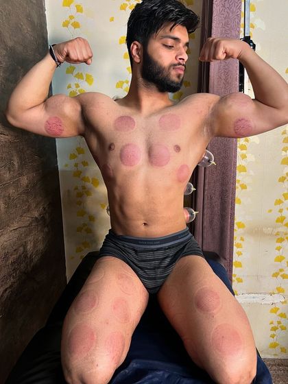 A client flexing after his full-body cupping therapy.
