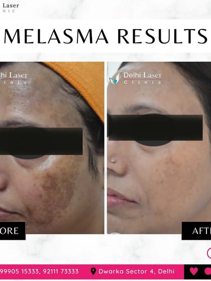 This is a powerful example of melasma reduction. My treatment plan, often involving the Q-Switch laser, targets these stubborn patches of pigmentation to significantly lighten them and restore an even skin tone.