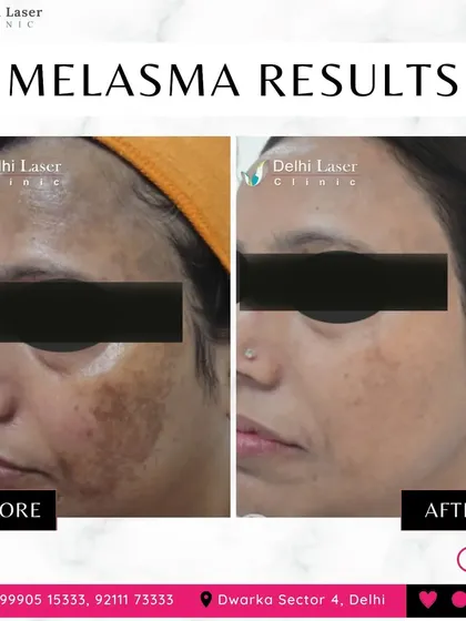 This is a powerful example of melasma reduction. My treatment plan, often involving the Q-Switch laser, targets these stubborn patches of pigmentation to significantly lighten them and restore an even skin tone.