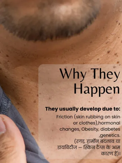 Skin tags are often caused by friction, but hormonal changes, genetics, and conditions like obesity and diabetes can also play a role. Understanding the cause can be part of managing them.