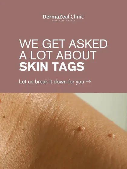 I get asked a lot about skin tags. This series of graphics breaks down what they are, where they appear, and how I use advanced laser technology to safely remove them.