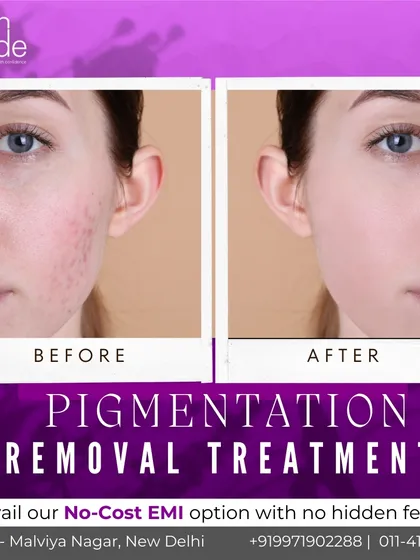 A clear example of how our pigmentation removal treatments work. We target dark spots and uneven tone to reveal a brighter, smoother complexion underneath.