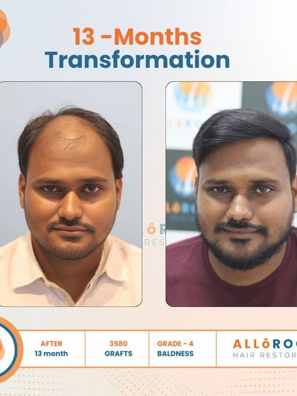This 13-month transformation of a Grade 4 baldness case was achieved with 3500 grafts. Notice the natural density and the restored hairline from all angles, including a close-up view of the new hair growth.