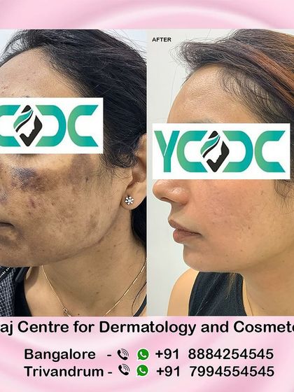 A clear before and after comparison of a patient who suffered from facial burns due to a treatment by a non-professional. My corrective protocol involved a series of treatments to safely clear the pigmentation.