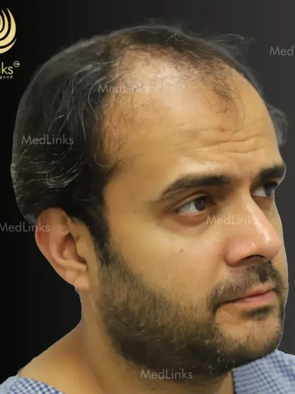 This patient presented with advanced hair thinning across the top of his scalp. His case required a comprehensive approach to restore both the hairline and the density on the crown.