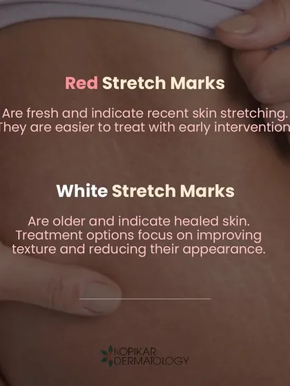 Red stretch marks are recent and easier to treat with early intervention, while white ones are older and treatment focuses on improving their texture. I offer several procedures to significantly reduce the appearance of both types.