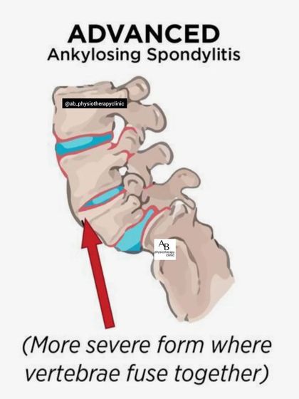 This image shows advanced ankylosing spondylitis, a condition where vertebrae fuse. We help manage the symptoms of spondylitis with mobility exercises and pain relief techniques.
