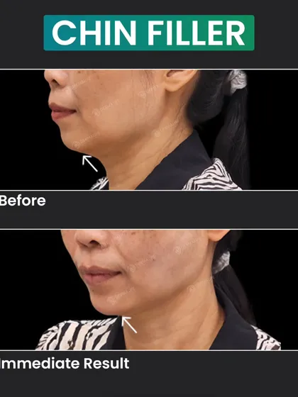 A well-defined chin is key to facial harmony. This before-and-after image shows the immediate result of using a chin filler to improve the patient's side profile and create a more balanced lower face.