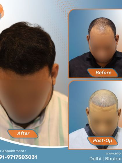 Another complete journey from before to post-op to a fantastic final result. This visual story demonstrates the effectiveness and predictability of my FUE hair transplant technique.