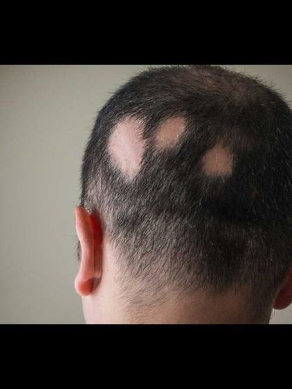 For patchy hair loss, or alopecia, my Ayurvedic treatment focuses on reactivating dormant hair follicles. This condition is linked to aggravated Vata and Pitta doshas. I use scalp massage (Shiro Abhyanga) with oils like Mahabhringraj Tailam and internal herbs to calm the system and improve blood supply to the scalp for natural regrowth.