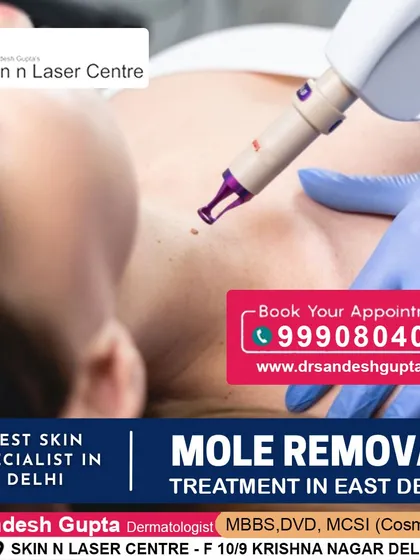 If you are looking for mole removal, our clinic in East Delhi provides expert treatment. We use precise laser technology for safe and effective removal.