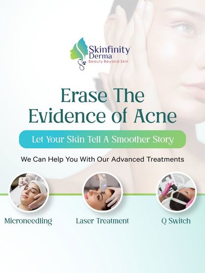 Let your skin tell a smoother story. We can help you erase the evidence of acne with advanced treatments like Microneedling, Laser Therapy, and Q-Switch, designed to restore your skin's smooth, flawless texture.