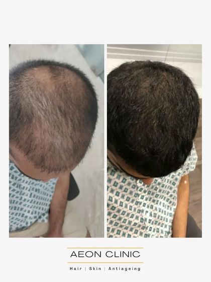 This before-and-after from a top-down view clearly illustrates the significant increase in hair density and coverage achieved for our client.