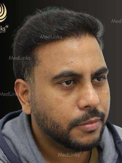 The final result from the side, showing a natural and dense hairline.