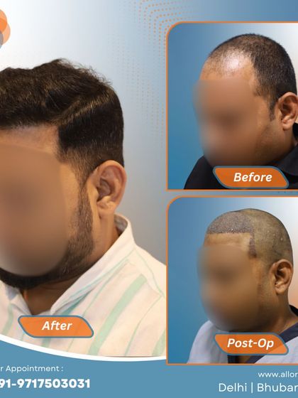 Another complete journey from before to post-op to a fantastic final result. This visual story demonstrates the effectiveness and predictability of my FUE hair transplant technique.