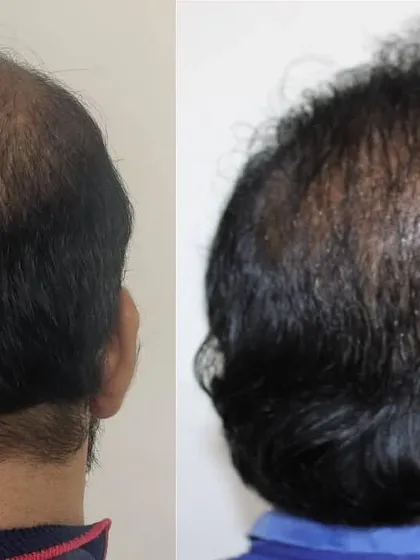 This before-and-after shot from the back highlights the significant improvement in coverage for the crown and upper scalp.