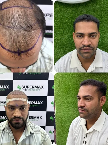 Dekho 7 mahine ka result. This is a complete before and after transformation with 4700 grafts. Notice the natural hairline and the density we achieved. This is the level of quality and artistry I promise every single client.