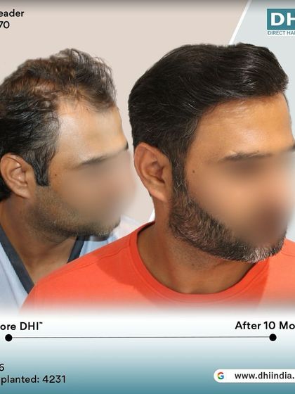 A before and after of a 36-year-old client 10 months post-procedure. With 4,231 hairs implanted, his hair is now dense, stylish, and completely natural-looking.