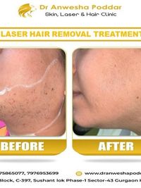 Laser Hair Removal