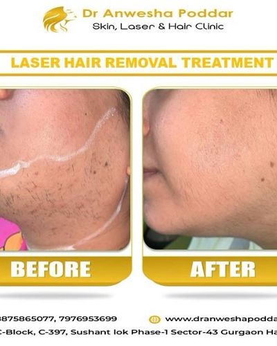 Laser Hair Removal