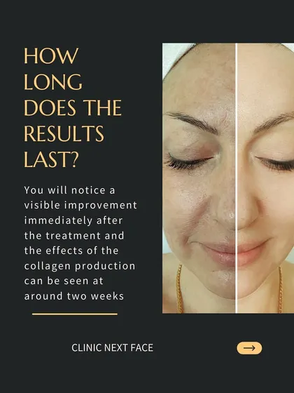 How long do the results of an Organic Lift last? You will notice a visible improvement immediately, with the effects of collagen production becoming more apparent after about two weeks.