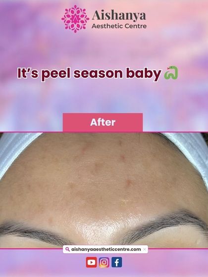 This is a great example of what a chemical peel series can achieve for hyperpigmentation. The 'after' photo shows a much clearer and more even-toned forehead, with the dark spots visibly faded.