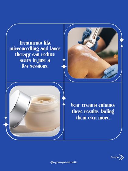 The best approach often combines professional treatments with at-home care. Procedures like microneedling and laser therapy can significantly reduce scars in just a few sessions, while scar creams can enhance and maintain those results.
