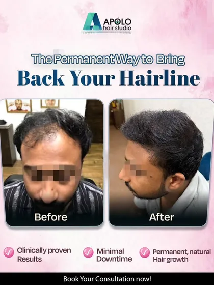 This client came to us looking for a permanent solution to hair loss. We delivered with a clinically proven hair transplant that offers natural, permanent hair growth with minimal downtime.