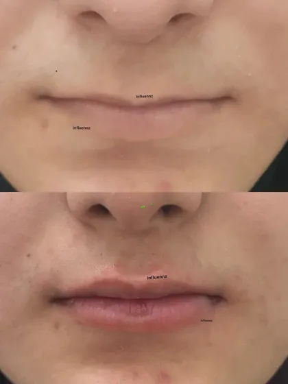 A clear before and after comparison of a lip filler treatment. Notice the improved volume and symmetry, which brings a youthful and refreshed look to the entire lower face.