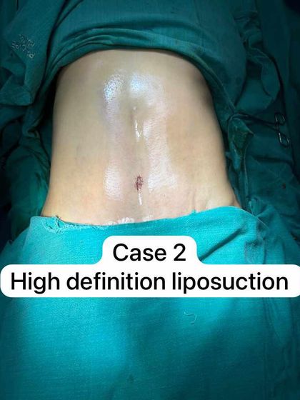 This image shows the immediate result of a high-definition liposuction case. The focus is on the sculpted appearance of the abdomen, with visible contouring and a defined midline.