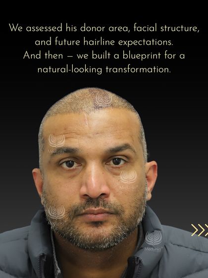 We assessed his donor area and facial structure to build a blueprint for a natural-looking transformation. This is him right after the procedure.