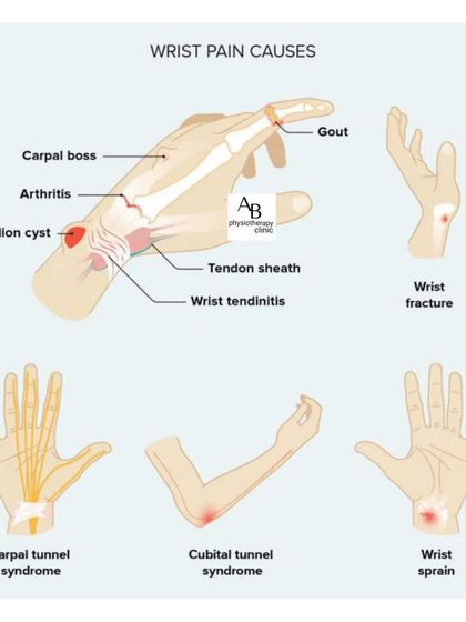 Wrist pain can have many causes, from carpal tunnel and arthritis to ganglion cysts and sprains. This guide illustrates some of the most common conditions we diagnose and treat.
