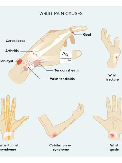 Wrist pain can have many causes, from carpal tunnel and arthritis to ganglion cysts and sprains. This guide illustrates some of the most common conditions we diagnose and treat.