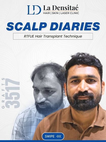 After years of dealing with hair loss, Pandurang Patil took charge of his journey. With 3,517 grafts using the RT-FUE technique, he’s not just seeing new growth, he’s living with renewed confidence every day.