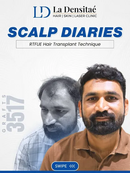 After years of dealing with hair loss, Pandurang Patil took charge of his journey. With 3,517 grafts using the RT-FUE technique, he’s not just seeing new growth, he’s living with renewed confidence every day.