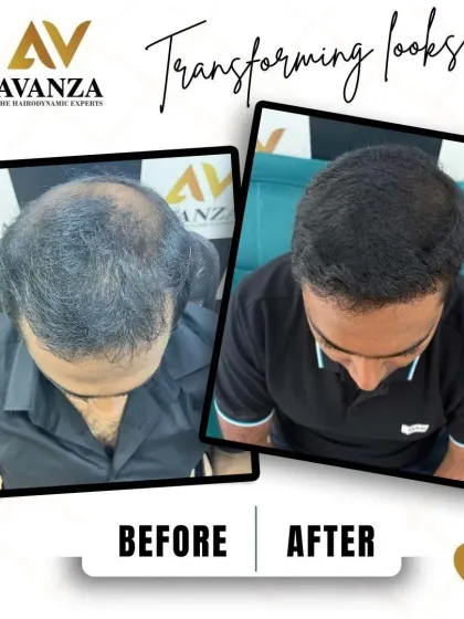 From a thinning crown to a full head of hair. This before and after shot clearly demonstrates the significant increase in density and coverage we can achieve.