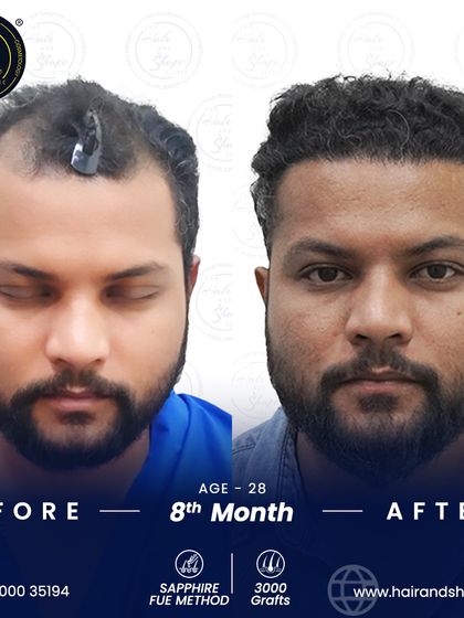 An 8-month progress shot after a 3000-graft Sapphire FUE transplant. The patient's new hairline looks natural and has significantly boosted his confidence.