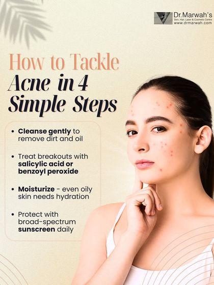 A consistent, correct skincare routine is fundamental for managing acne. This guide outlines four simple but crucial steps: gentle cleansing, targeted treatment with active ingredients, proper moisturization, and daily sun protection to support your clinical procedures.