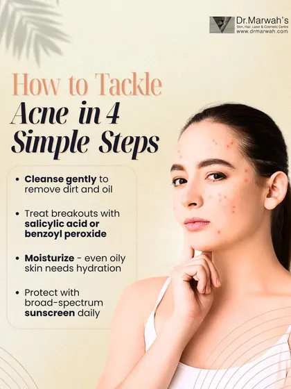 A consistent, correct skincare routine is fundamental for managing acne. This guide outlines four simple but crucial steps: gentle cleansing, targeted treatment with active ingredients, proper moisturization, and daily sun protection to support your clinical procedures.