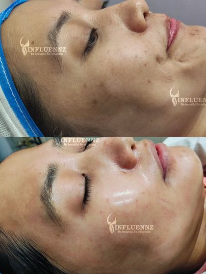 The Radiant Blend facial at work. You can see how this treatment effectively tackled dullness and uneven skin tone, leaving the client with a visibly brighter and more radiant complexion.
