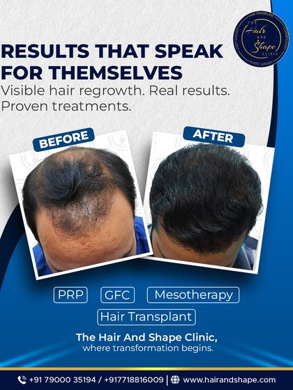 Visible hair regrowth and real results. This image shows the effectiveness of our treatments, including hair transplant, for achieving a fuller look.