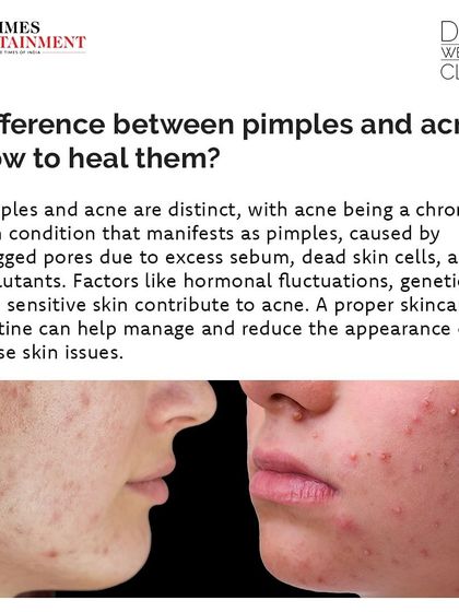 The main graphic from my Times Entertainment feature, highlighting the difference between pimples and the chronic skin condition of acne.