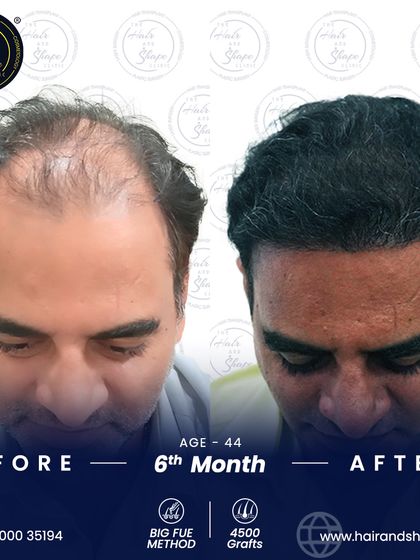 At 44 years old, this patient opted for a 4500-graft BIG FUE transplant. This 6-month result shows a significant and life-changing improvement.